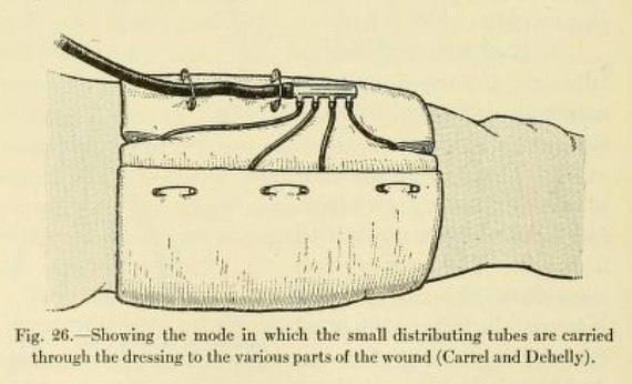  Carrel Dakin treatment. The treatment of war wounds. by Keen, William W. 1918 (Public Domain) 